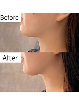 ヒカリエステ 六本木(HIKARI ESTHE)/切らない小顔リフト