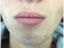 スプレール 水戸店/ヒゲ脱毛6ヶ月8回施術