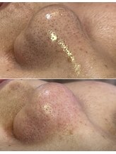 しらゆき 名古屋黒川/毛穴エクストラクション