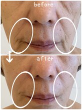 アム(Ame)/ほうれい線・もたつきもスッキリ