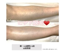 アルーア(Allure)/ヒザ下脱毛♪before after