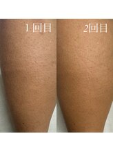 フェリーチェネイル(felice Nail)/メンズ脚脱毛