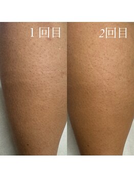 フェリーチェネイル(felice Nail)/メンズ脚脱毛