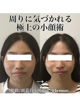 エレミュー(Elemue)/極上小顔術
