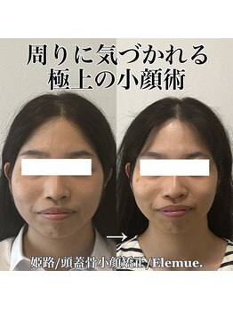 エレミュー(Elemue)/極上小顔術