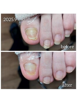 【皮膚にめりこんだ爪】