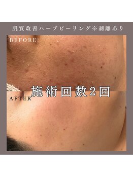 ベルミー(Bellmi)/肌質改善ハーブピーリング(顔)