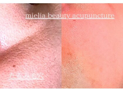 ミエリア美容鍼灸院(mielia美容鍼灸院)の写真