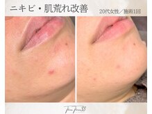 スリースリー 恵比寿(THREE THREE)/ニキビ・肌荒れケア