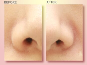 ジュリア オージェ 天王寺店/ビフォーアフター（鼻スパ）