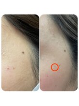 エヌ スタイル(N Style)/シミ改善