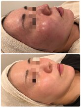 ベルミナ(BE.LMINA)/ザラつき、赤み、ニキビケア