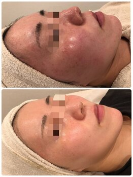 ベルミナ(BE.LMINA)/ザラつき、赤み、ニキビケア