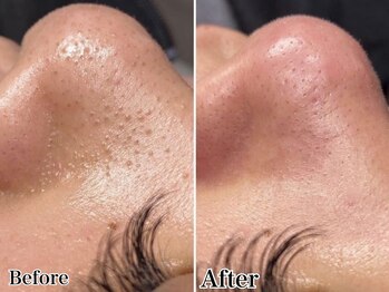 エミマス ボーテ(Emimas Beaute’)/３０代 毛穴洗浄＋お顔全体WAX