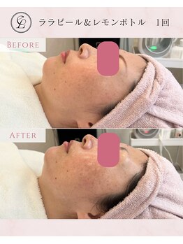 エンルーチェ(en;Luce)/ララピール×レモンボトルコース