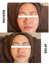 ゼロ 水戸店(ZERO)/シミ・シワ肌質改善スペシャル