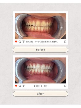 スマイルプライベートビューティサロン(Smile)/セルフホワイトニング