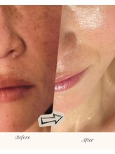 ビューティーライフ(beauty life)/韓国肌　グレーズソフトピール