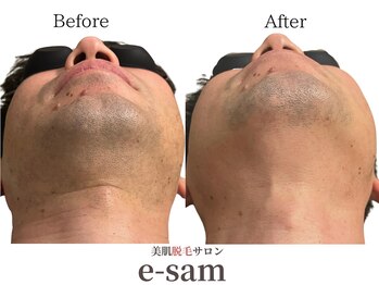 イーサム(e-sam)/髭脱毛