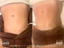 バーリブール 恵比寿店(BERLIBUR)/ハイパーナイフEX＆インド痩身