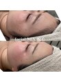 インク(ink)&nbsp;facial MIX 脱毛＾＾即日ツルツル肌になれちゃいます^_^