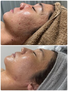 ディーロータス(D-lotus)/肌質改善／毛穴/アクネケア