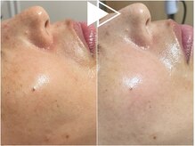 リシェス(Richesse)/くすみ、シミ改善★初回¥11990