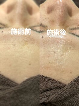 ツール(TOOL)/ハーブピーリング