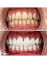 ホワイト 福岡博多店(WHITE)/ホワイトニングビフォーアフター