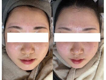 ビーマジック(Be Magic)/毛穴/毛穴洗浄/小顔/アイブロウ