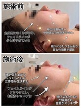 ミヨン ヨコハマ(Miyonne Yokohama)/LDM Aqua＋小顔ヘッドスパ上大岡