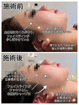 ミヨン ヨコハマ(Miyonne Yokohama)/LDM Aqua＋小顔ヘッドスパ上大岡