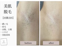 サロン ド パーフェクション(Salon de Perfection)/脱毛