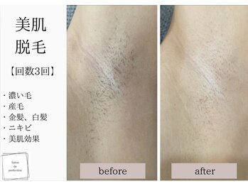 サロン ド パーフェクション(Salon de Perfection)/脱毛