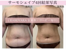 ラエッセ(La Esse)/お腹の脂肪＆ゆるみ諦めないで！