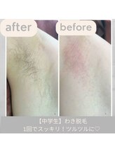 シュガーリングハウスレディ(SugaringHouse LADY)/【中学生】わき脱毛