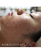 スピカ(Spica)/☆私も肌ボロボロの人でした！