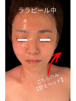 ジーニー(Genie)/ララピール中の「整えヘッド」