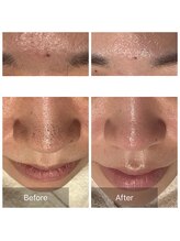 アヴニール 光の森(AVENIR)/毛穴洗浄☆3回の効果