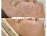 【ニキビ集中ケア改善プログラム】繰り返すニキビにお悩みの方。