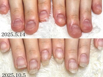 グラシナ なんば店/深爪/噛み/むしり癖/長さだし