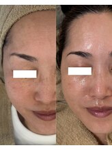 てづか整骨院 西都院/バクテリウムピール