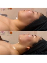 【ハーブピーリング/毛穴洗浄/小顔リフト】total beauty salon mayahime 大宮店/オンダリフト