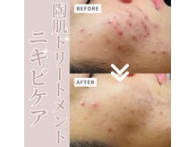 ルーク(Luke)の雰囲気(繰り返すニキビに、本気の肌改善ケア☆陶器のような肌へ。)