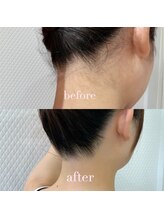 ココポキ 岐阜店/うなじ脱毛　5回