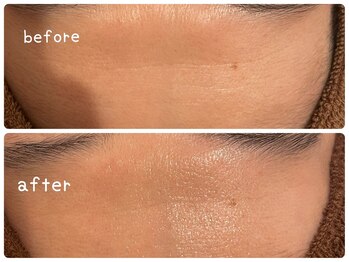 ヒメミ(Himemi)/BBL光エステ