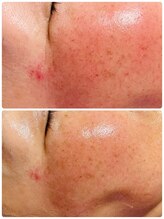 リラキュート(Rela Cute)/ピーリング&レチノールパック