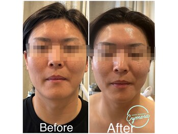 ケイビューティーサロン(K BeautySalon)/顔面輪郭特化術リガメントコルギ