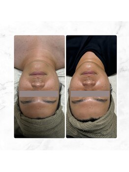 サラン(SALON)/メンズ ビフォーアフター