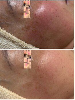 トータルビューティー ココ(Total Beauty CoCo)/50代・シミケア肌質改善(6回)